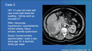 Case 3: Right-Sided Varicocele Leads To Discovery Of Kidney Tumor Treatment