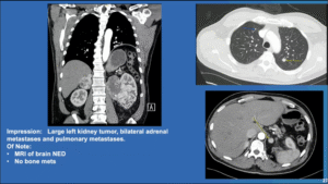 Case 4- Systemic Therapy And Surgical Options For Metastatic Renal Cell Carcinoma