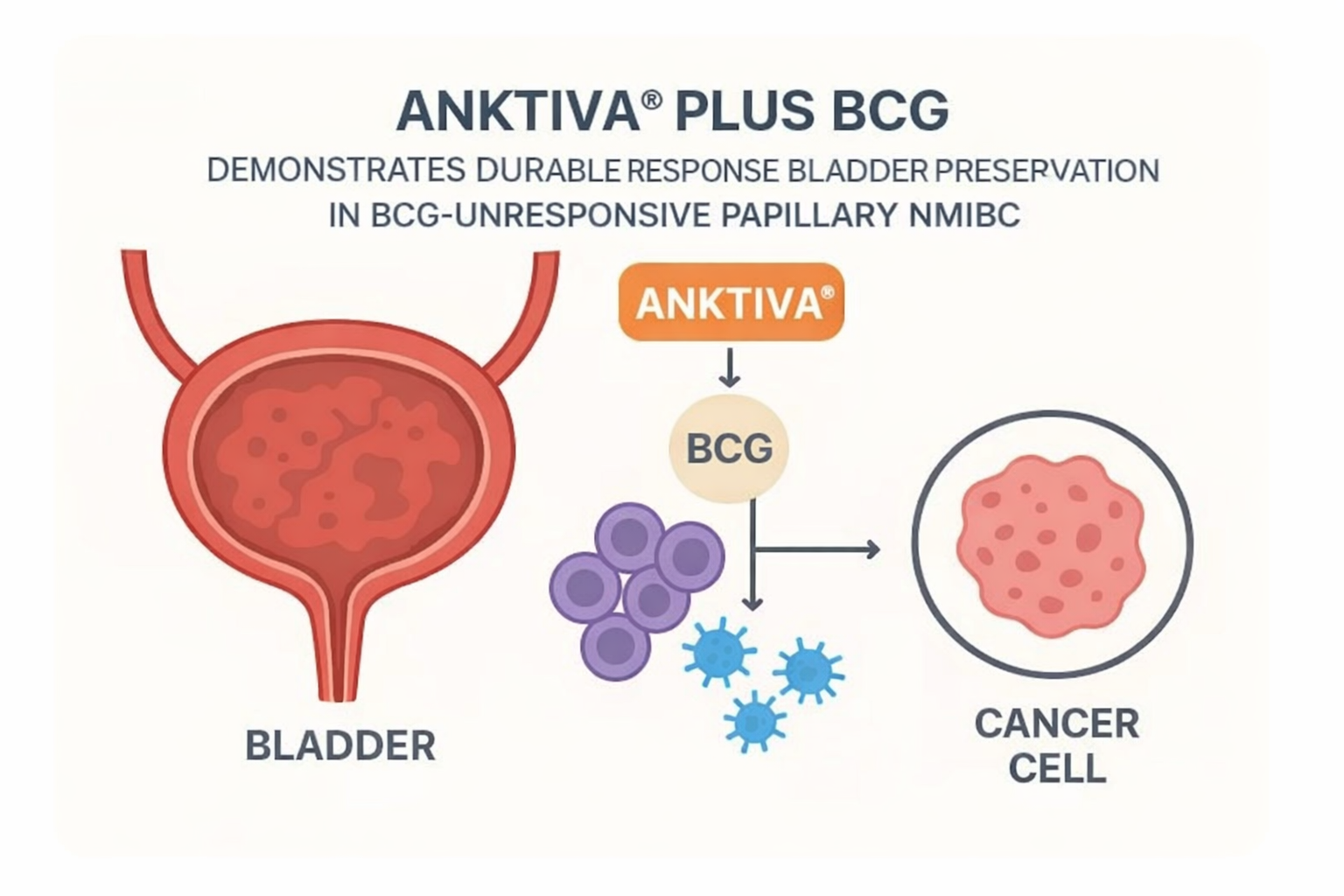 IL-15 Receptor Lymphocyte–Stimulating Agent NAI + BCG in BCG-Unresponsive Papillary-Only NMIBC